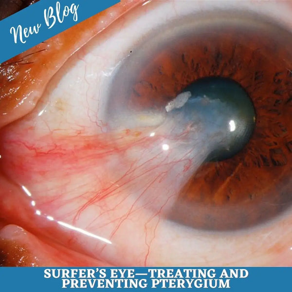 Surfer’s Eye—Treating and Preventing Pterygium